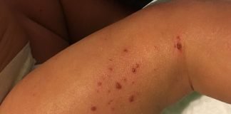 Afectiunile cutanate