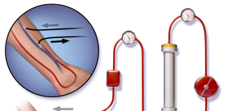 Afla istoricul dializei si rolul ei in tratamentul insuficientei renale! Afla istoricul dializei si rolul ei in tratamentul insuficientei renale
