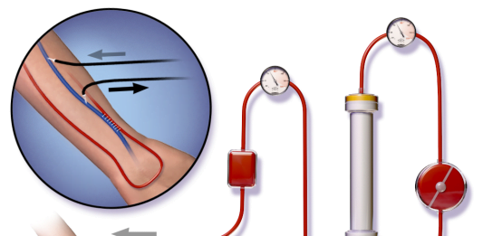 Afla istoricul dializei si rolul ei in tratamentul insuficientei renale