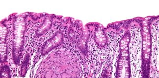 Boala Crohn - o inflamatie problematica a colonului