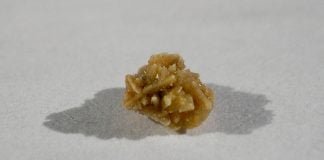 Calculii renali – cauzele si tratamentul litiazei renale Calculii renali - cauzele si tratamentul litiazei renale