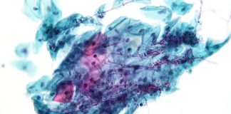 Candida - boala cu transmitere sexuala