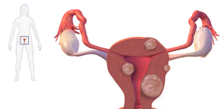 Fibromul uterin