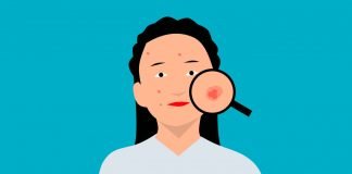 Furunculul - inamic al frumusetii, metode de tratament