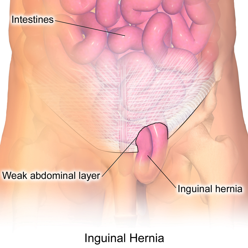Hernia inghinala