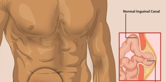 Hernia inghinala - cauze, simptome, tratament