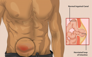 Hernia inghinala - cauze, simptome, tratament