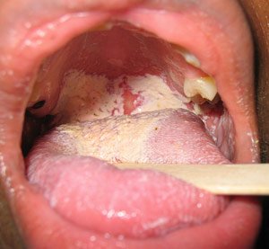 Infectie cu candida, Foto: acupunctureforall.blogspot.ro