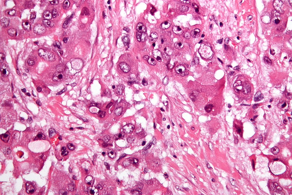 cancer hepatic