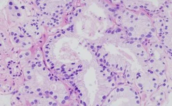 Adenomul de prostata - cauze, simptome si tratament