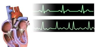 Aritmia – Tulburarile de ritm cardiac Aritmia - Tulburarile de ritm cardiac
