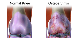 Artrita genunchiului - cauze si tratament