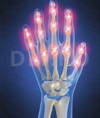 Artrita psoriazica