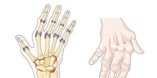 Artrita reumatoida - cauze si tratament