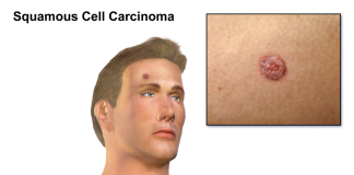 Cancerul de piele – cauzele si tratamentul melanomului Cancerul de piele - cauzele si tratamentul melanomului