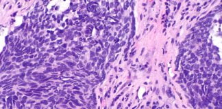 Cancerul pulmonar – cauze si tratament Cancerul pulmonar - cauze si tratament