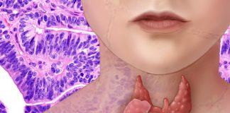 Cancerul tiroidian Cancerul tiroidian