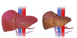 Ciroza hepatica - cauze, simptome si tratament