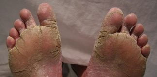 Ciuperca piciorului - cauze si tratament