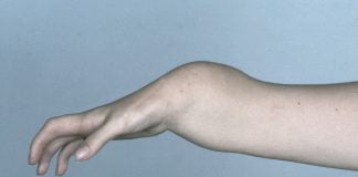 Encefalita – cauze, simptome, tratament Encefalita - cauze, simptome, tratament