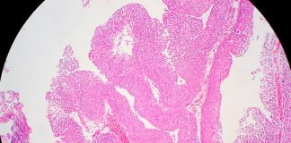 Infectia tractului urinar – cauze, simptome si metode de tratament