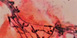 Infectiile vaginale micotice Infectiile vaginale micotice