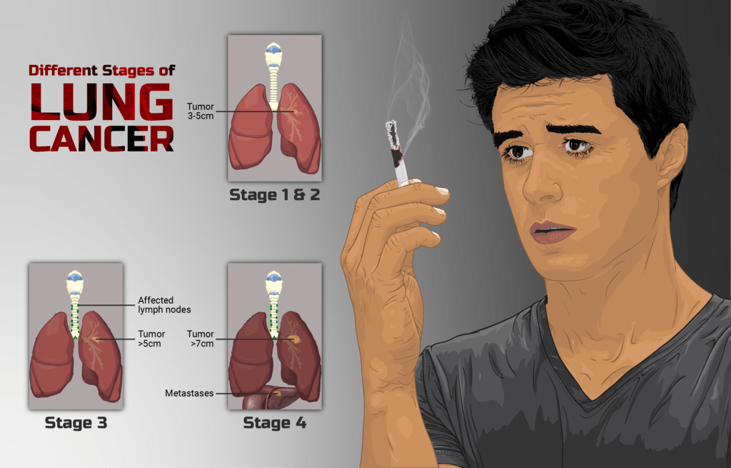 cancer pulmonar