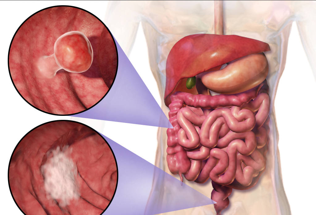 Cancerul colorectal - cauze si tratament