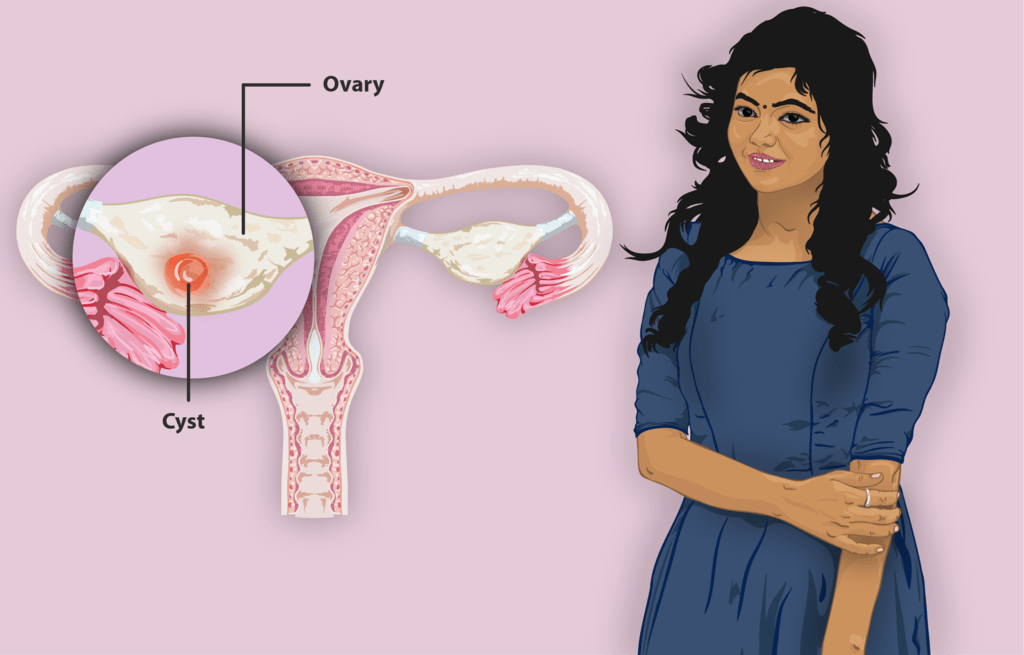 chist ovarian