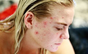 Cum scap de acnee cand tratamentele obisnuite nu functioneaza? Cum scap de acnee cand tratamentele obisnuite nu functioneaza