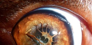 Top 10 cele mai ciudate boli din lume