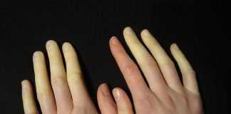 Boala Raynaud, reactie cutanata severa la frigBoala Raynaud, reactie cutanata severa la frig