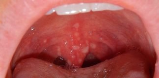 Herpangina, o boala infectioasa mai putin cunoscuta - Simptome si tratament
