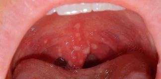 Herpangina, o boala infectioasa mai putin cunoscuta - Simptome si tratament