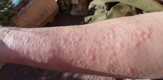 Care sunt cauzele ce provoaca reactia alergica de urticarie? Care sunt cauzele ce provoaca reactia alergica de urticarie