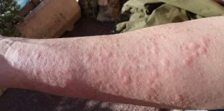 Care sunt cauzele ce provoaca reactia alergica de urticarie