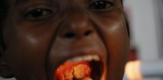 Crupul laringian, difterie cu localizare laringiana Crupul laringian, difterie cu localizare laringiana