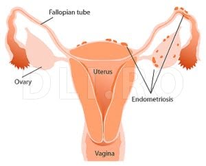 Endometrioza-Boala-Ginecologica.jpg