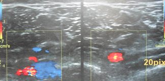 Tromboza venoasa profunda Tromboza venoasa profunda