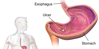 Cum tratam ulcerul gastroduodenal