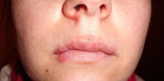 Leziunea herpetica, metode de tratament