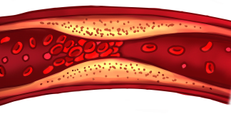 Cheaguri de sange – Cauze si metode de tratament