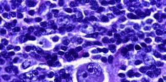 Cum se manifesta Limfomul Hodgkin sau cancerul sistemului limfatic