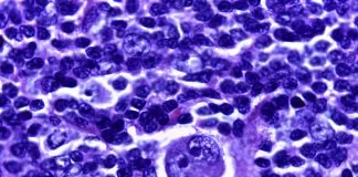 Cum se manifesta Limfomul Hodgkin sau cancerul sistemului limfatic