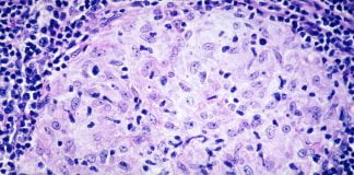 Granulomul inghinal sau donovanoza, o boala deosebit de contagioasa