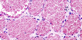 Hemangioamele - Tumori vasculare de tip benign