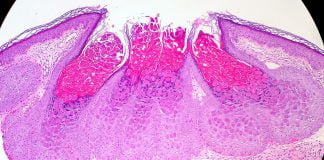 Afla metodele de tratament pentru Molluscum Contagiosum, o boala virala de piele!