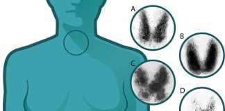 Boala Basedow Graves - Gusa exoftalmica, metode de tratament
