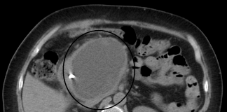 Chistul pancreatic - Cum apare si ce simptome creeaza in organism