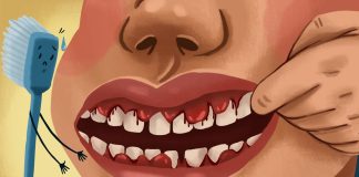 Gingivita – Cauze si metode de tratament